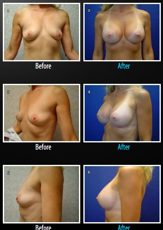 breast-augmentation-before-and-after-photos-dr.-Smith