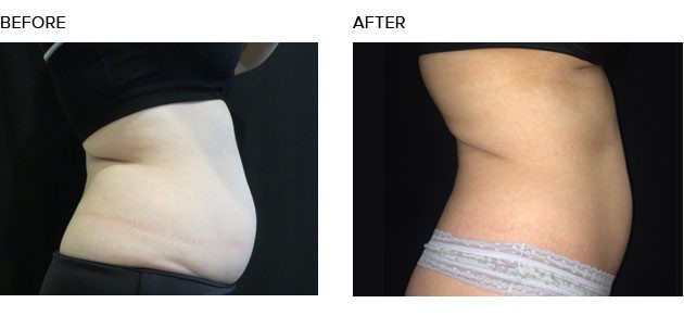 Smith Surgery-CoolSculpting patient, before and after photo